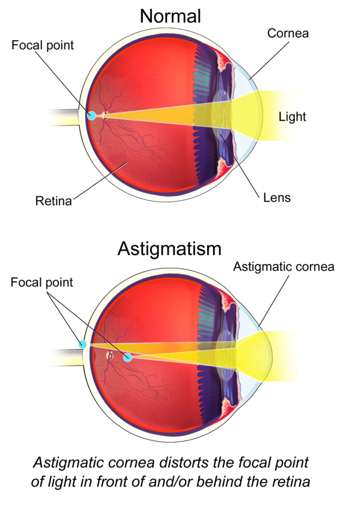 Ortho K Treatment Astigmatism The Ortho K Group