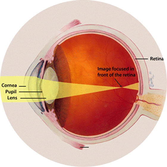 Myopia Correction & Control. Ortho K Treatment - The Ortho K Group